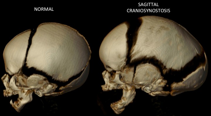 Sagittal+Skull+Side