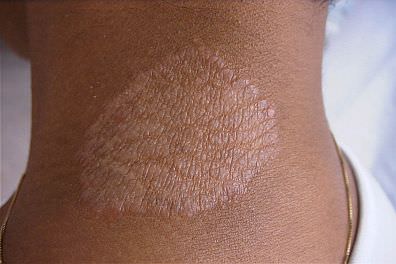 granulomaannulare_mini