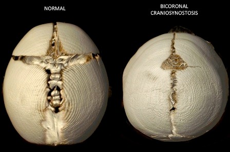 Bilateral+Coronal+Synostosis+Top