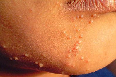 Molluscum_Contagiosum_mini