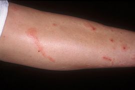 Contactdermpoisonivy_TN