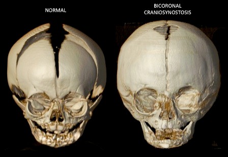 Bilateral+Coronal+Synostosis+front