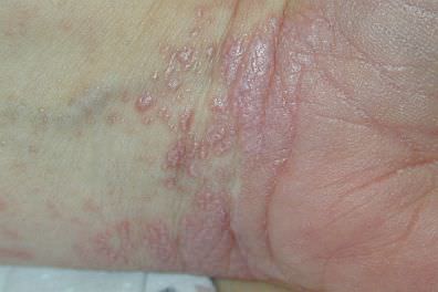 Lichenplanus396x264_mini