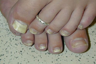 onychomycosis_396x264_1_mini