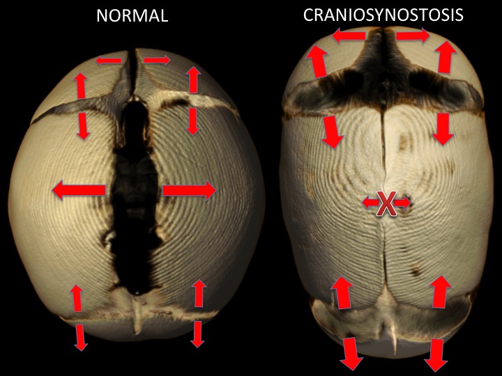 Craniosynostosis