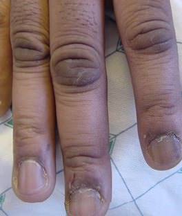 Acanthosis+396x264_mini