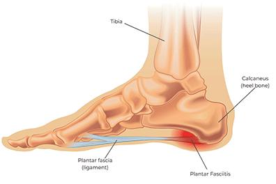 Shutterstock_1958600653-Plantar-Fasciitis-396x264