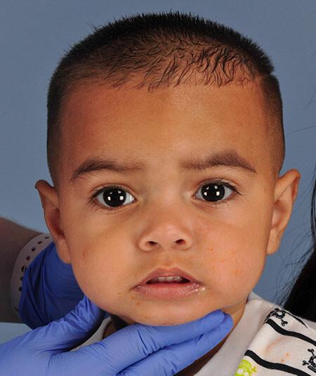 Armani Castillo-Rosales (DOB 11/12/2016 ) Armani was treated for a hemangioma on his left cheek. Starting at 2 months old he underwent propranolol treatment, and is looking great at a recent visit at 17 months old. There are 2 additional photos of different angles.