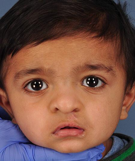 Yusuf Farooqi (DOB 3/10/2017) before Unilateral cleft lip and palate surgery. 4 additional photos are used from different angles.