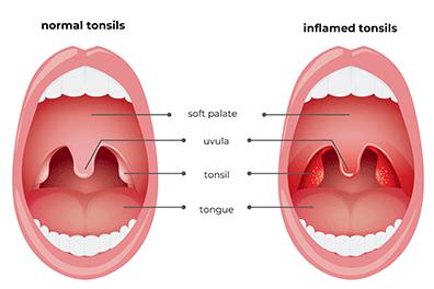 Shutterstock_417077221-Tonsillitis-396x264