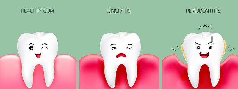 Shtterstock_644166139-Periodontics-800x300