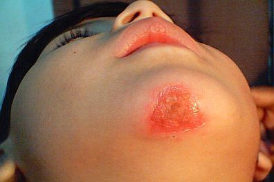 Impetigo_mini