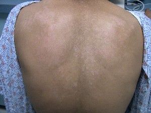 Tinea_Versicolor_mini