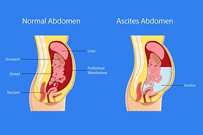 Shutterstock_1247788795-Ascites-396x264