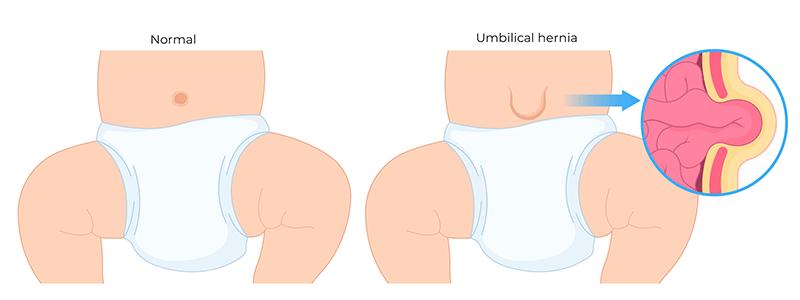 Shutterstock_2298890407-Umbilical-Hernia-800x300