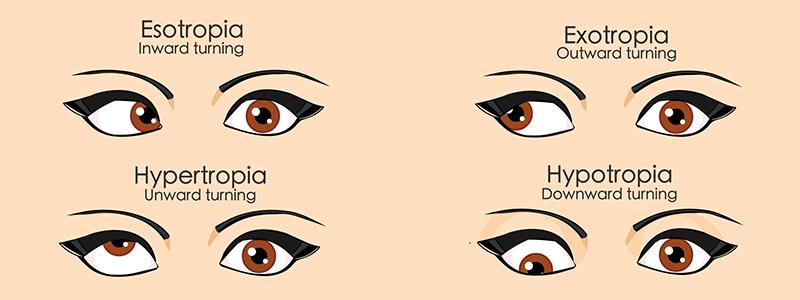 Shutterstock_1970136718-Strabismus-800x300