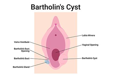 Shutterstock_2348478147-Bartholins-Cyst-396x264