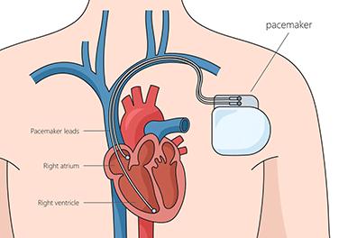 Shutterstock_2425822831-Pacemaker-396x264