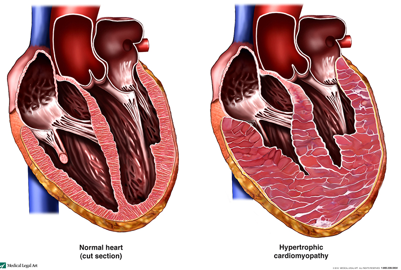 hypertrophic-cardiomyopathy-si55550921-540x800