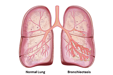 Shutterstock-2167023909_Bronchiectasis-396x264