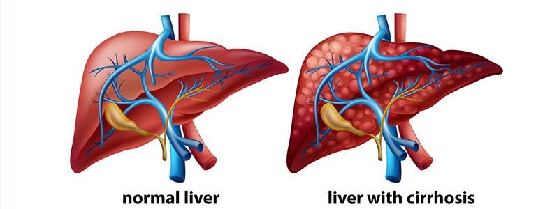 Shutterstock_3132824810-Cirrhosis-of-the-liver-800x300