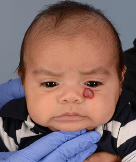 Armani Castillo-Rosales (DOB 11/12/2016 ) Armani was treated for a hemangioma on his left cheek. Starting at 2 months old he underwent propranolol treatment, and is looking great at a recent visit at 17 months old. There are 2 additional photos of different angles.