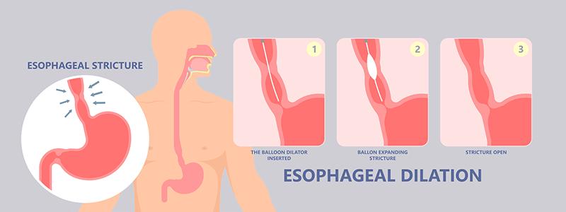 Shutterstock_1825701950-Esophageal-Stricture-800x300