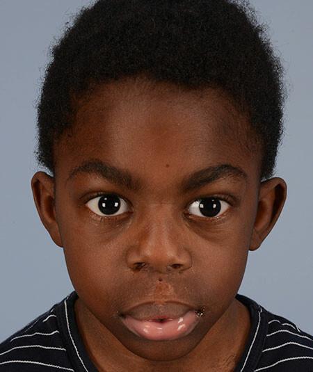 A cleft lip repair elsewhere left Luc with skin covering his upper teeth. Surgical lip revision restored function and appearance. DOB 2/11/2011. 6 additional photos are used at different angles