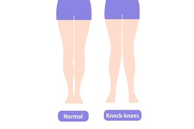 Shutterstock_1576029694-knock-knees-396x264