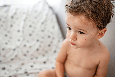 Stock-Photo-ID-1504253891_Chicken-Pox-396x264